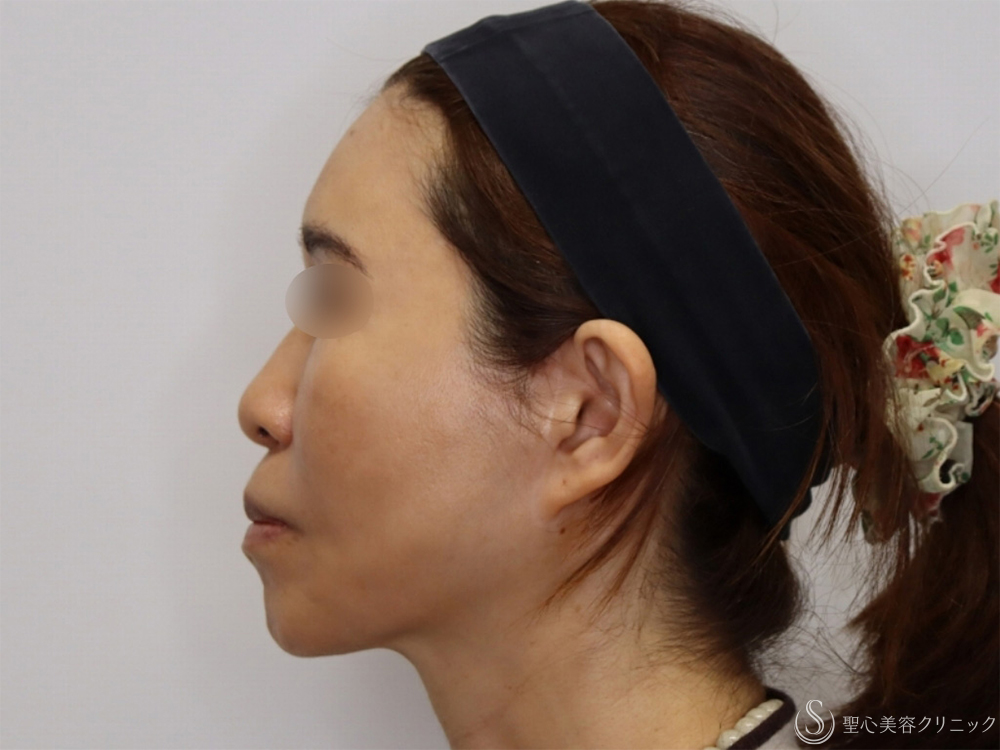【50代女性・フェイスリフト並みの効果の糸リフト】アンカーDXダブル（1ヶ月後） After 