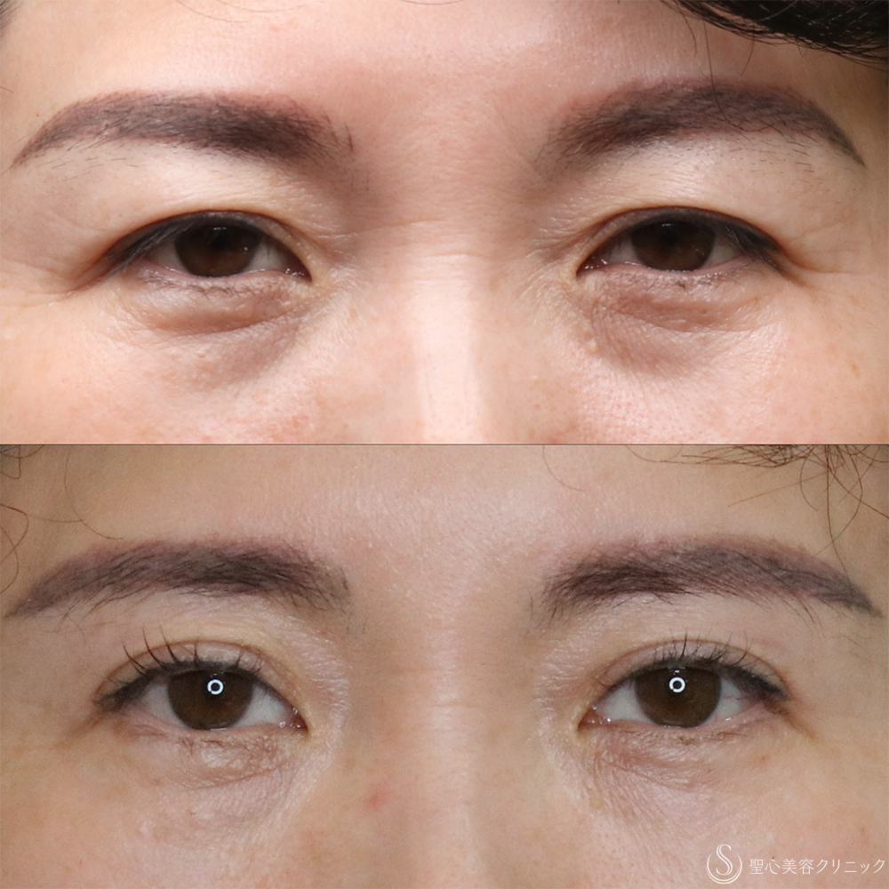 【40代女性・まぶたすっきり】眉下切開法（眉下リフト）（4ヶ月後） After 名古屋・まぶたのタルミ取り・二重・ぱっちり二重・眉下切開