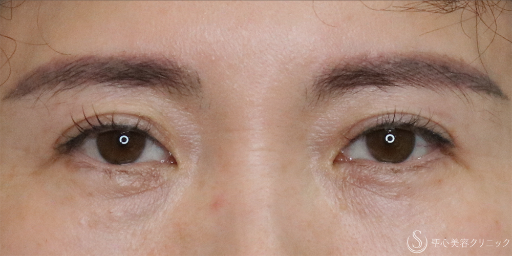 【40代女性・まぶたすっきり】眉下切開法（眉下リフト）（4ヶ月後） After 名古屋・まぶたのタルミ取り・二重・ぱっちり二重・眉下切開