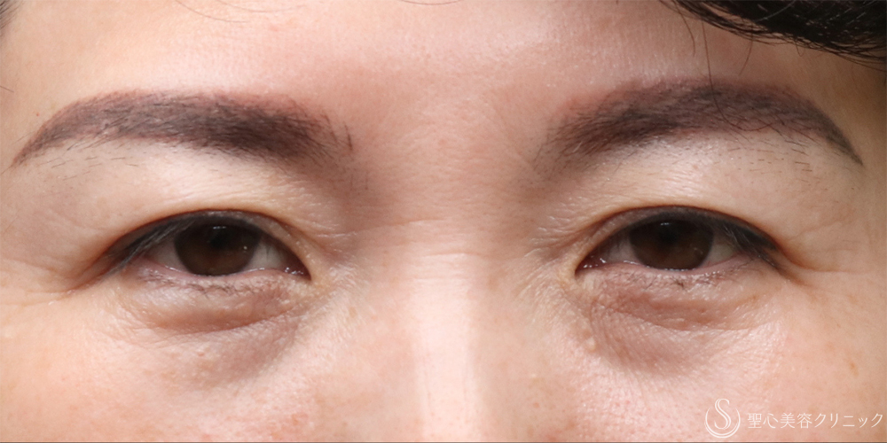 【40代女性・まぶたすっきり】眉下切開法（眉下リフト）（4ヶ月後） Before 名古屋・まぶたのタルミ取り・二重・ぱっちり二重・眉下切開