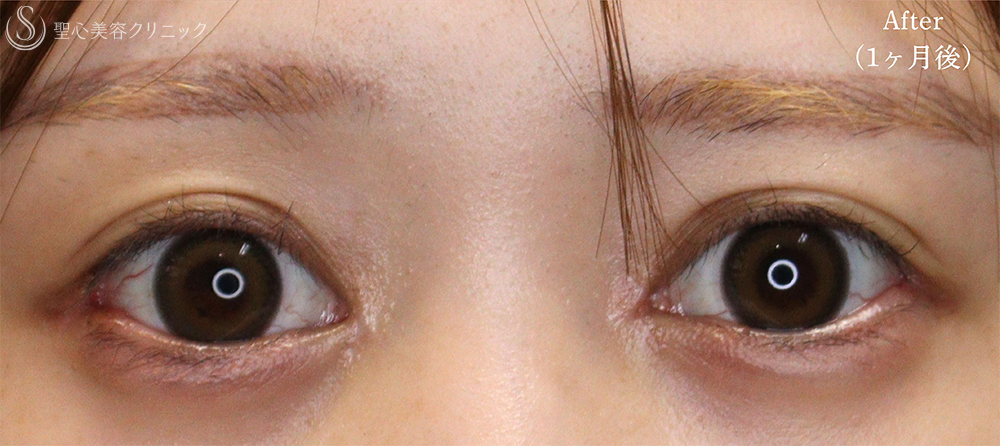 【20代女性・目頭と目尻の相乗効果で目を大きく】目頭切開＋目尻切開（1ヶ月後） After 
