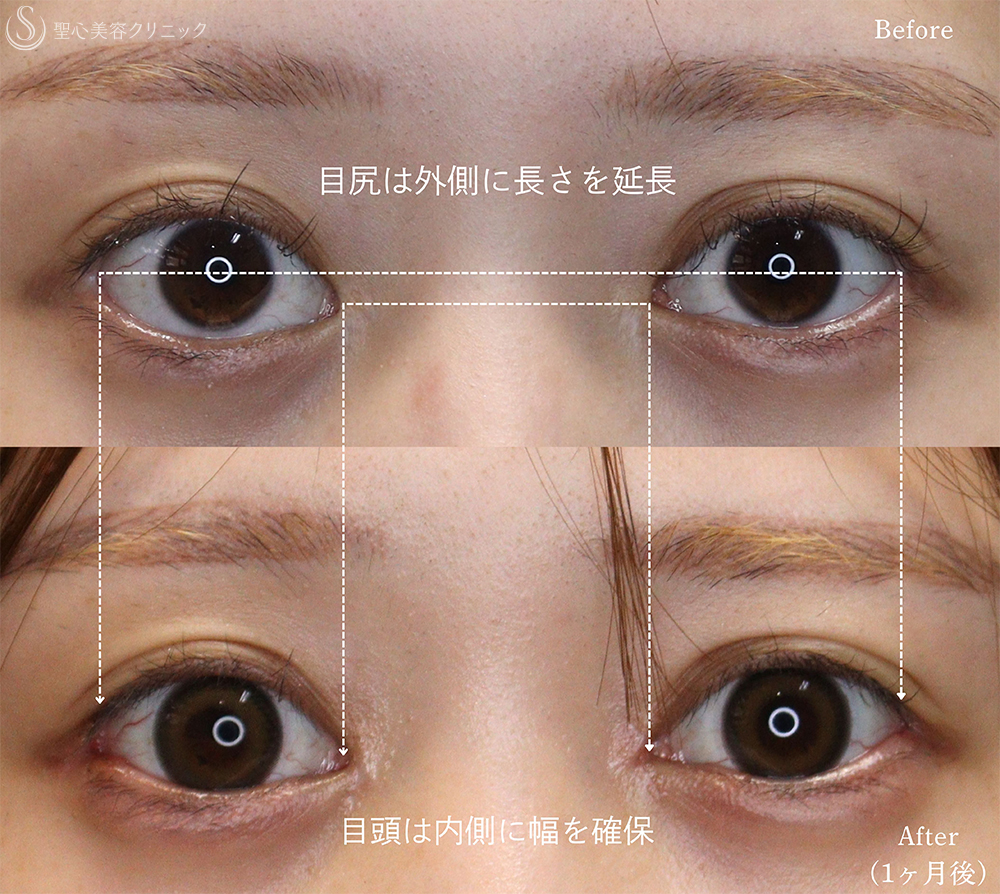 【20代女性・目頭と目尻の相乗効果で目を大きく】目頭切開＋目尻切開（1ヶ月後） After 