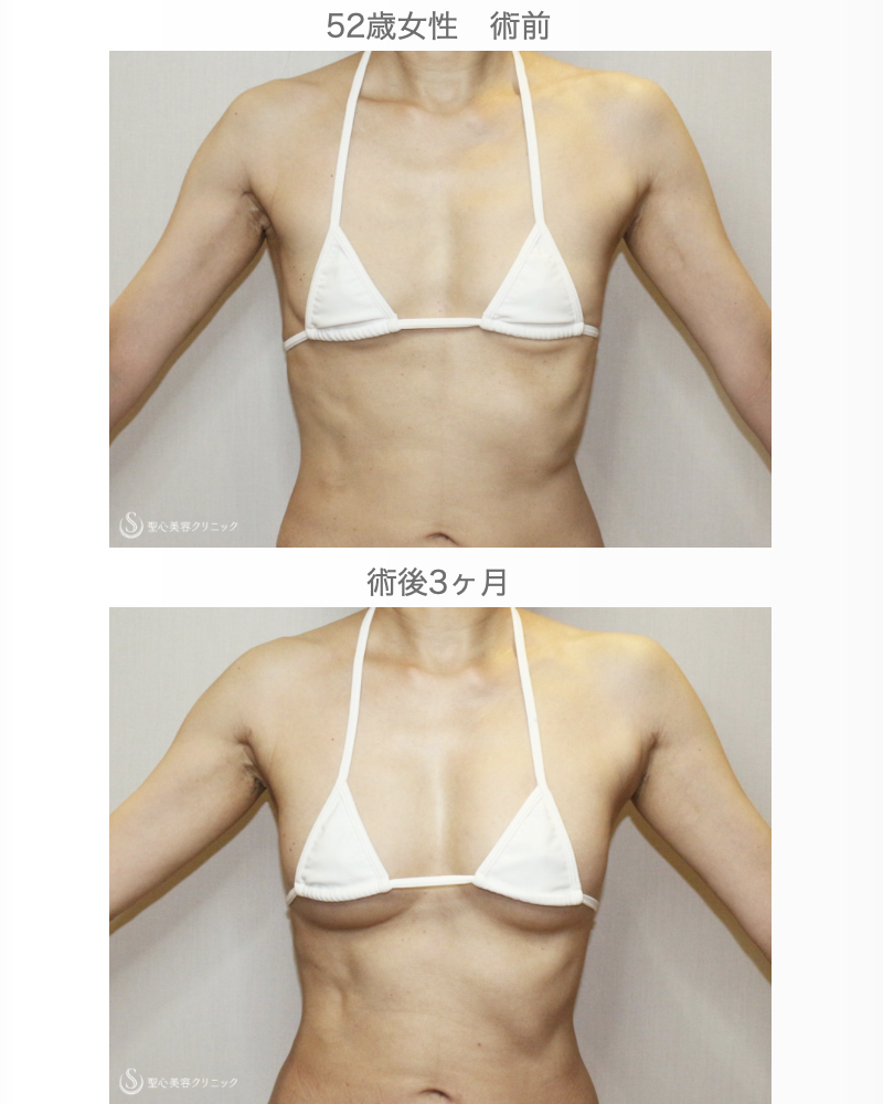 【52歳女性・自然なバストアップ】プレミアムセリューション豊胸術（3日目〜3ヶ月後） After 