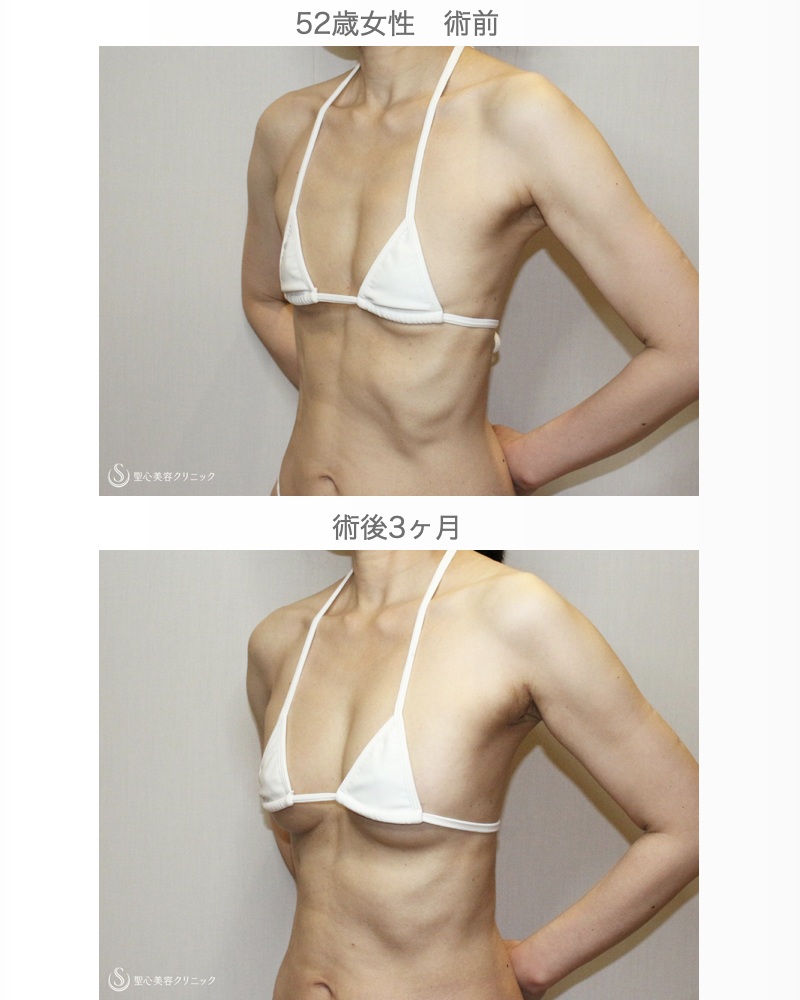 【52歳女性・自然なバストアップ】プレミアムセリューション豊胸術（3日目〜3ヶ月後） After 