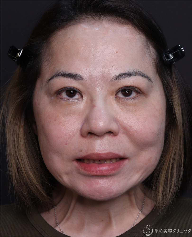【50代女性・ほうれい線、マリオネットライン】レスチレンディファイン（2週間後） After 