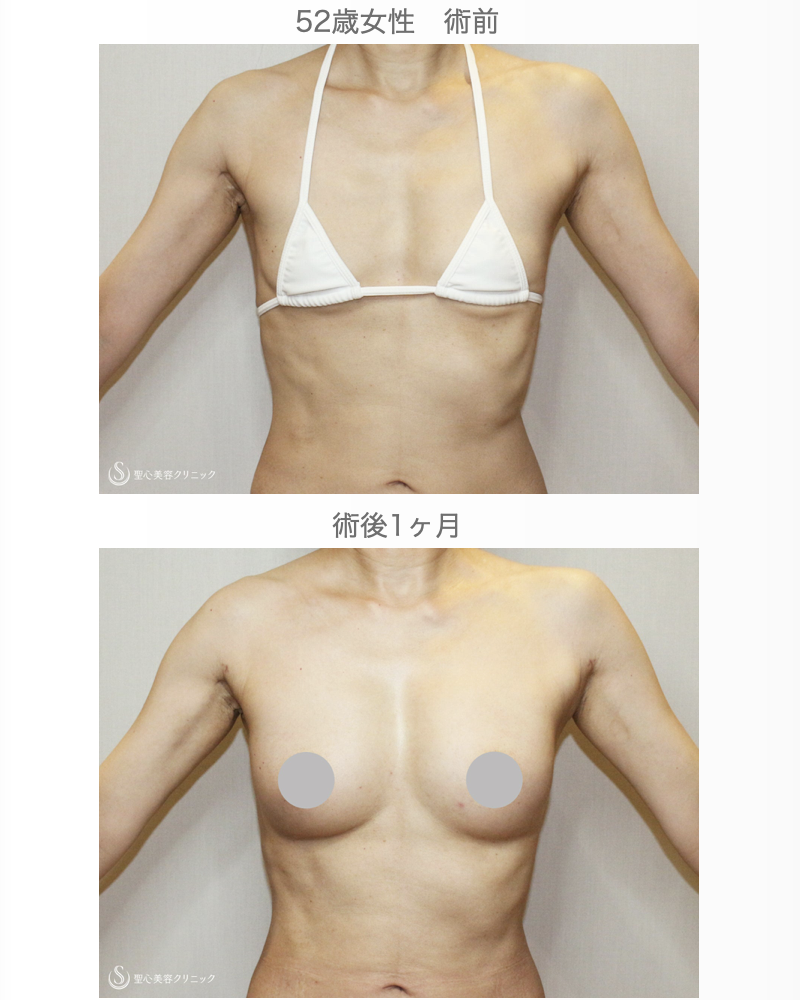【52歳女性・自然なバストアップ】プレミアムセリューション豊胸術（3日目〜1ヶ月後） After 