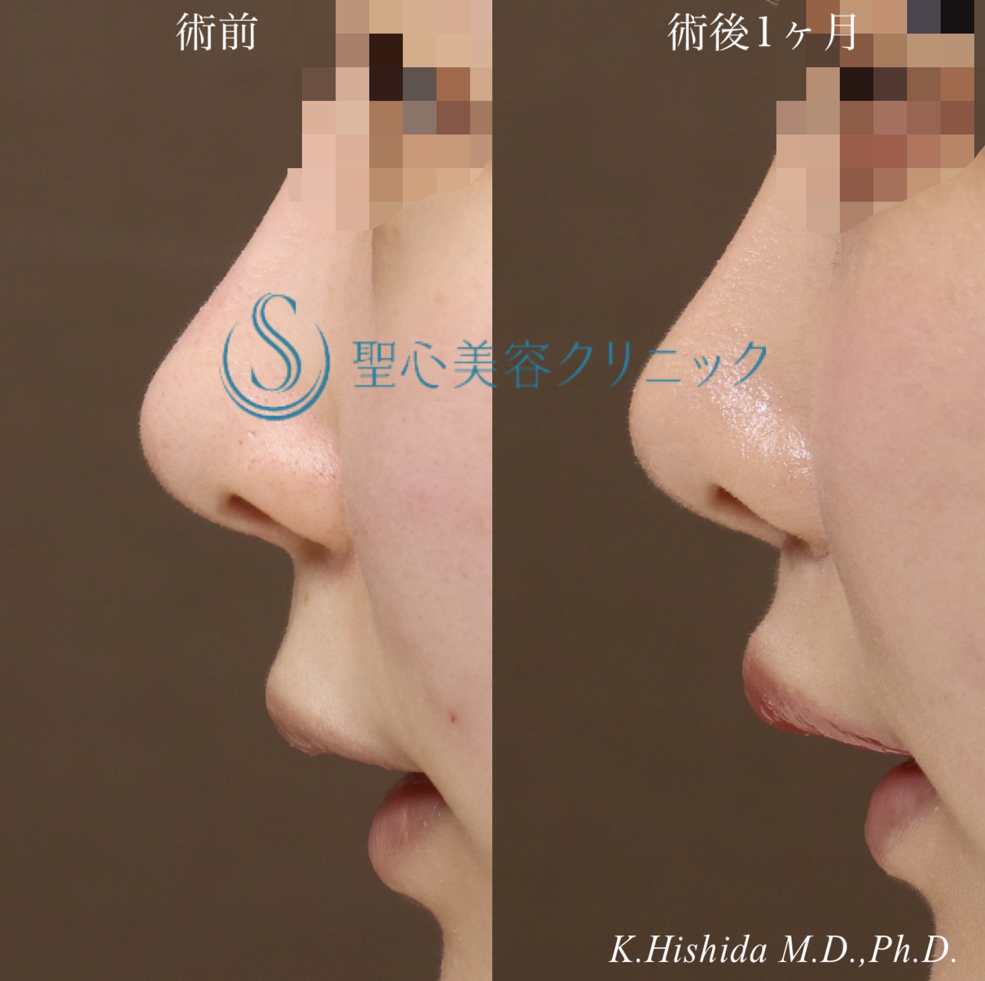 【20代女性・口元を可愛く整えたい！！】プレミアムリップリフト（プレミアム人中短縮術）＋プレミアム口角挙上術（1ヶ月後） After 
