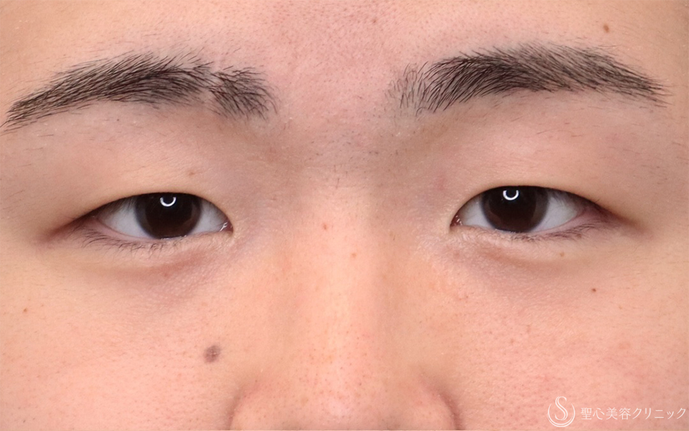 【30代男性・自然な目元に】二重埋没法：ダブルノット法＋涙袋ヒアルロン酸（1ヶ月後） Before 