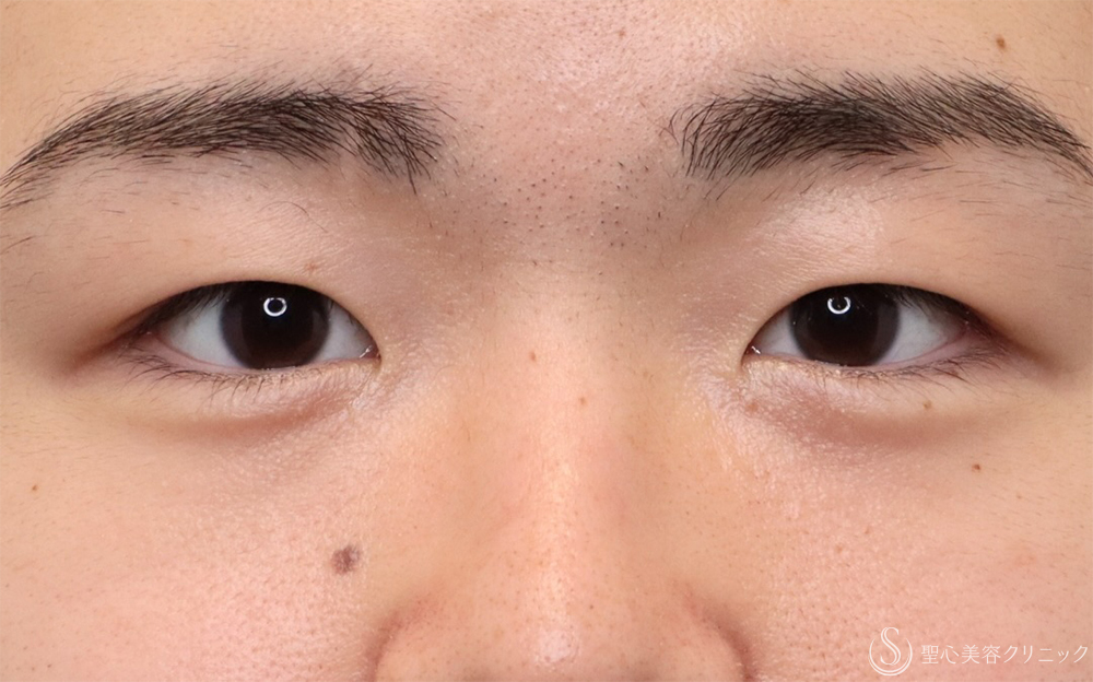 【30代男性・自然な目元に】二重埋没法：ダブルノット法＋涙袋ヒアルロン酸（1ヶ月後） After 
