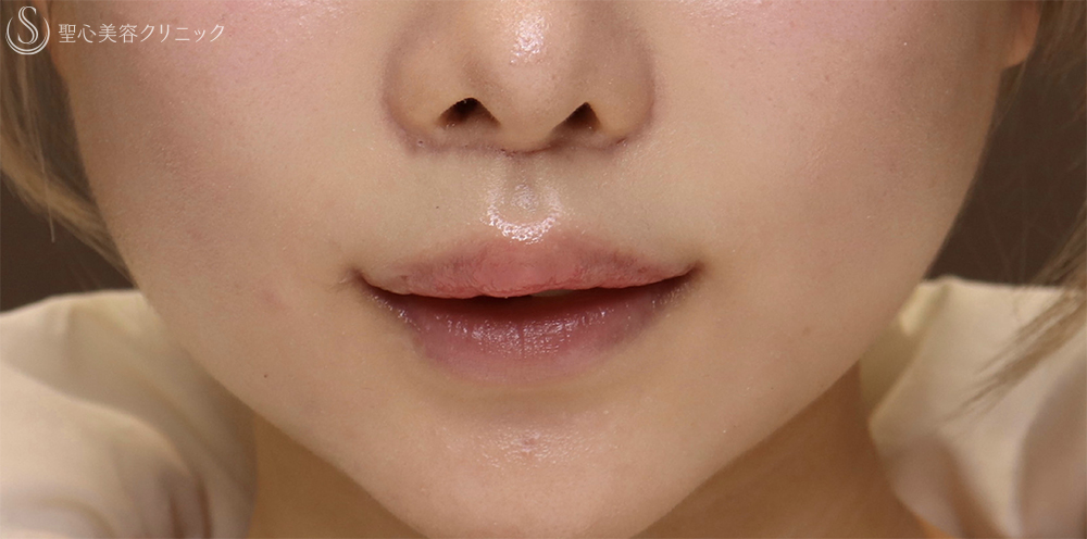 【20代女性・口元を可愛く整えたい！！】プレミアムリップリフト（プレミアム人中短縮術）＋プレミアム口角挙上術（1ヶ月後） After 