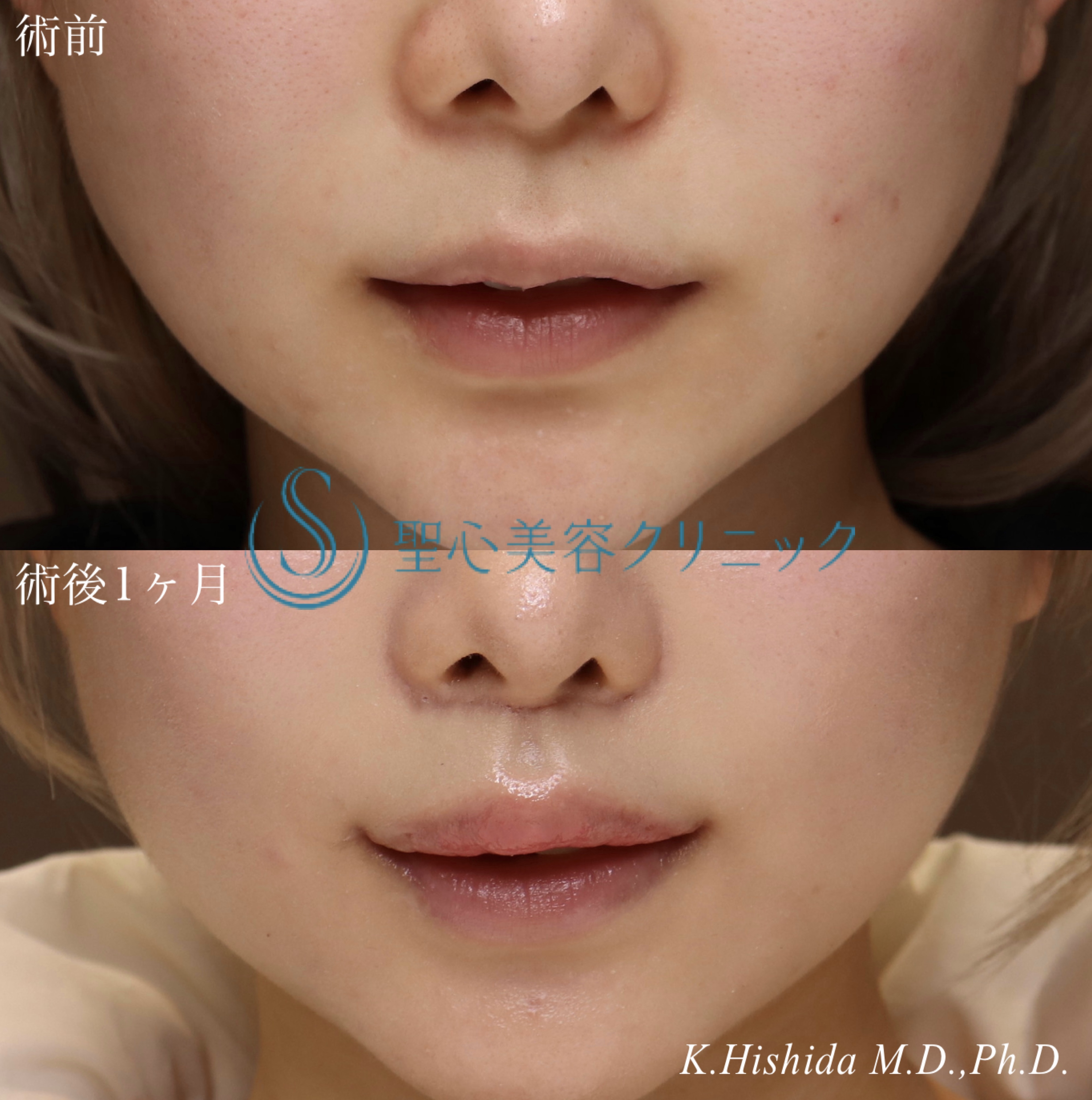 【20代女性・口元を可愛く整えたい！！】プレミアムリップリフト（プレミアム人中短縮術）＋プレミアム口角挙上術（1ヶ月後） After 