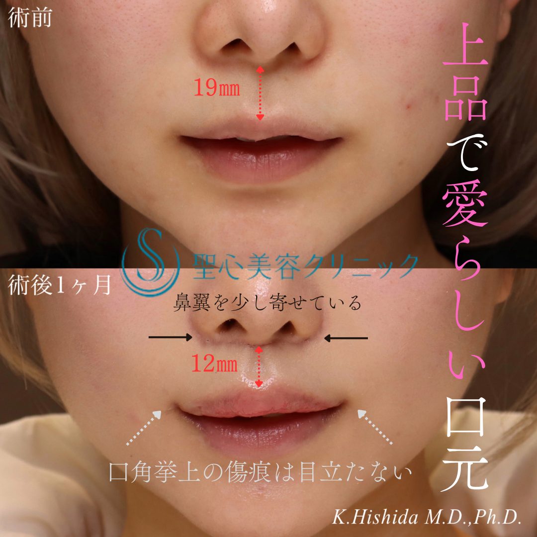 【20代女性・口元を可愛く整えたい！！】プレミアムリップリフト（プレミアム人中短縮術）＋プレミアム口角挙上術（1ヶ月後） After 