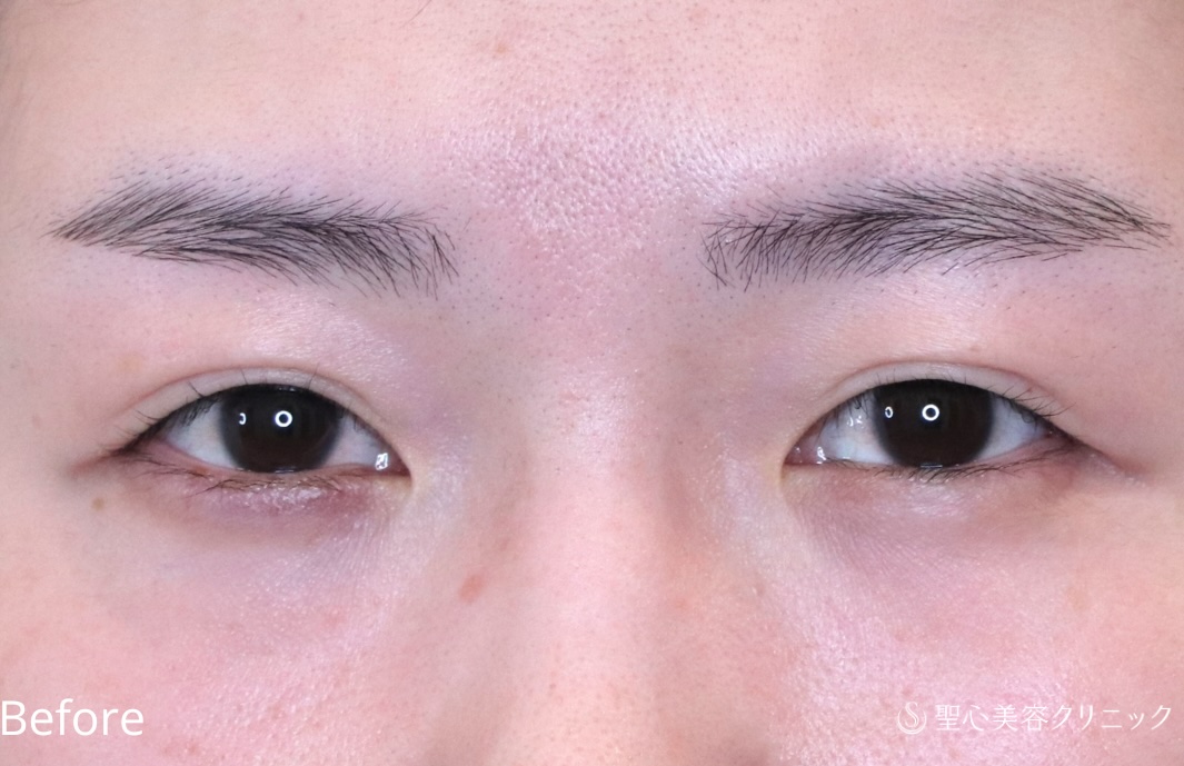 【20代女性・埋没法でゆるんだ二重を引き締める】二重切開法（1週間後） Before 