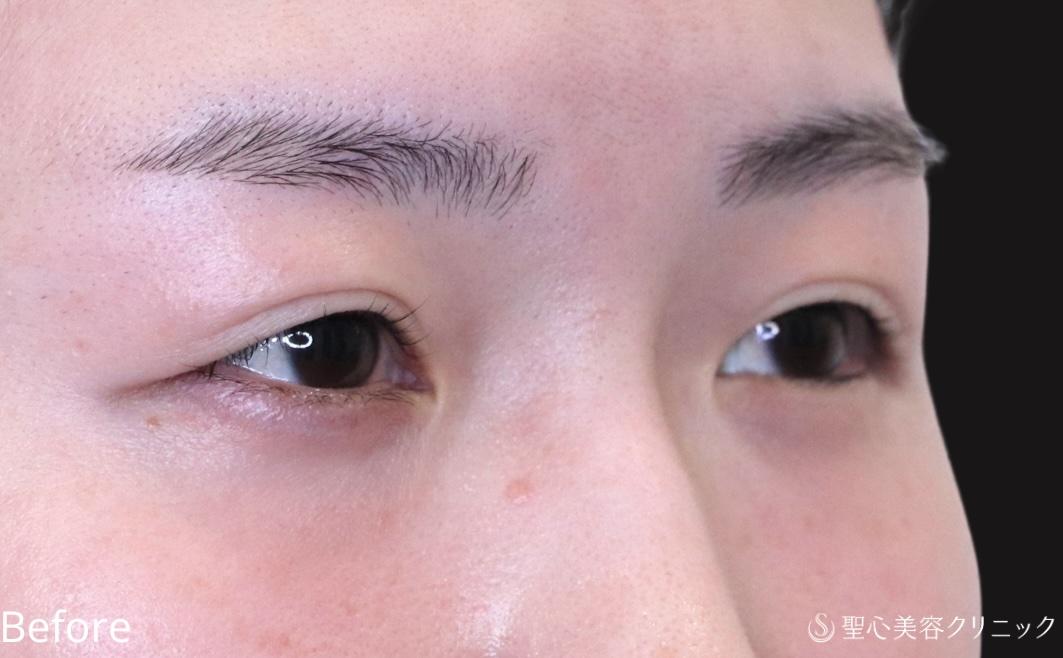 【20代女性・埋没法でゆるんだ二重を引き締める】二重切開法（1週間後） Before 