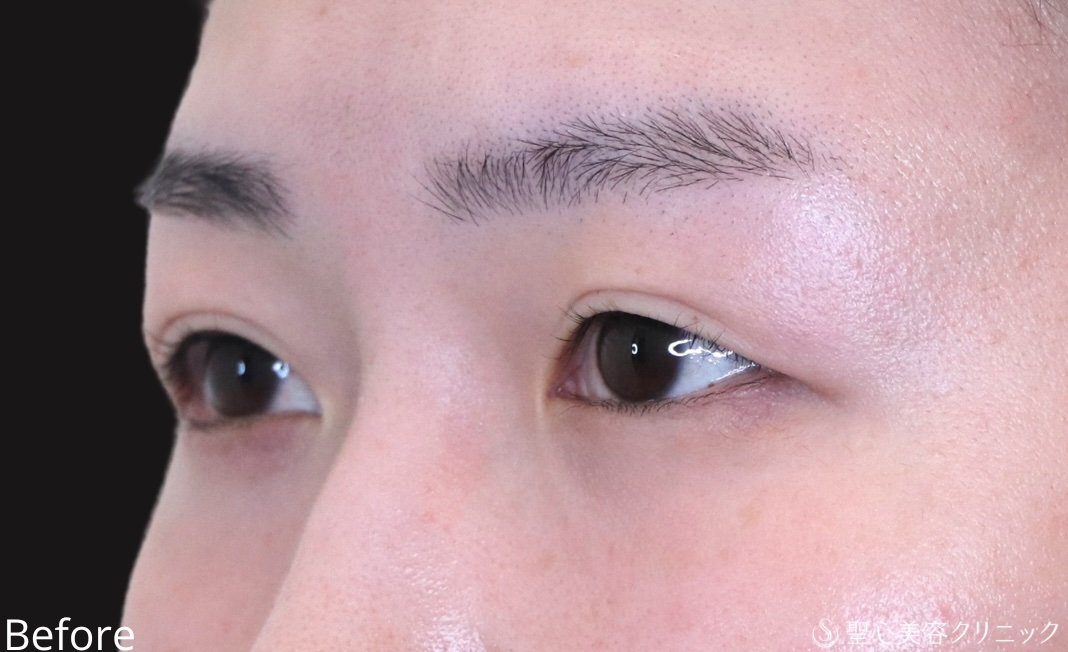 【20代女性・埋没法でゆるんだ二重を引き締める】二重切開法（1週間後） Before 