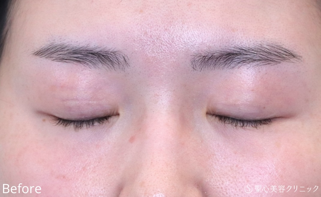 【20代女性・埋没法でゆるんだ二重を引き締める】二重切開法（1週間後） Before 