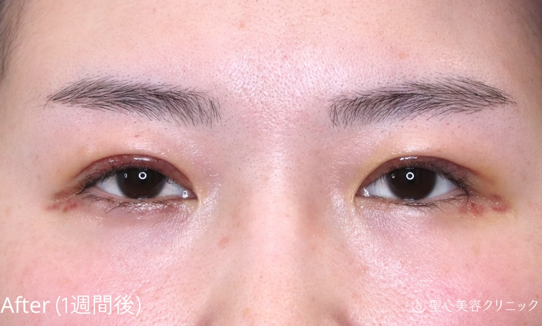 【20代女性・埋没法でゆるんだ二重を引き締める】二重切開法（1週間後） After 