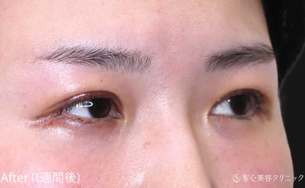【20代女性・埋没法でゆるんだ二重を引き締める】二重切開法（1週間後） After 