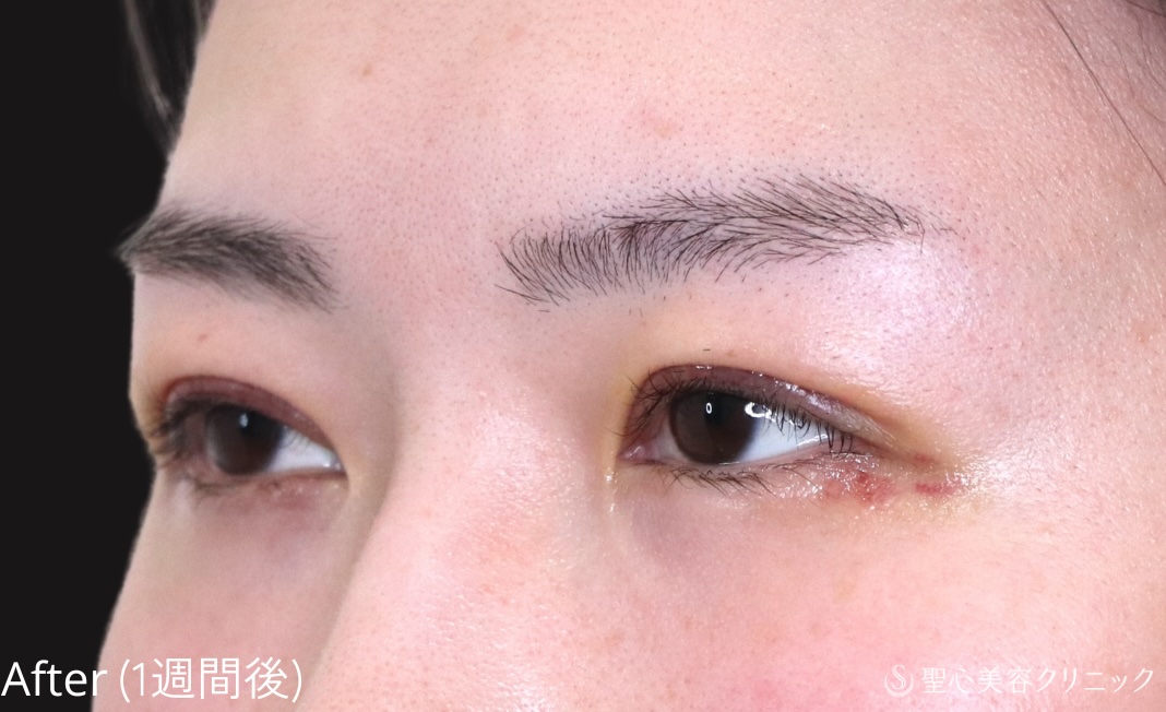 【20代女性・埋没法でゆるんだ二重を引き締める】二重切開法（1週間後） After 