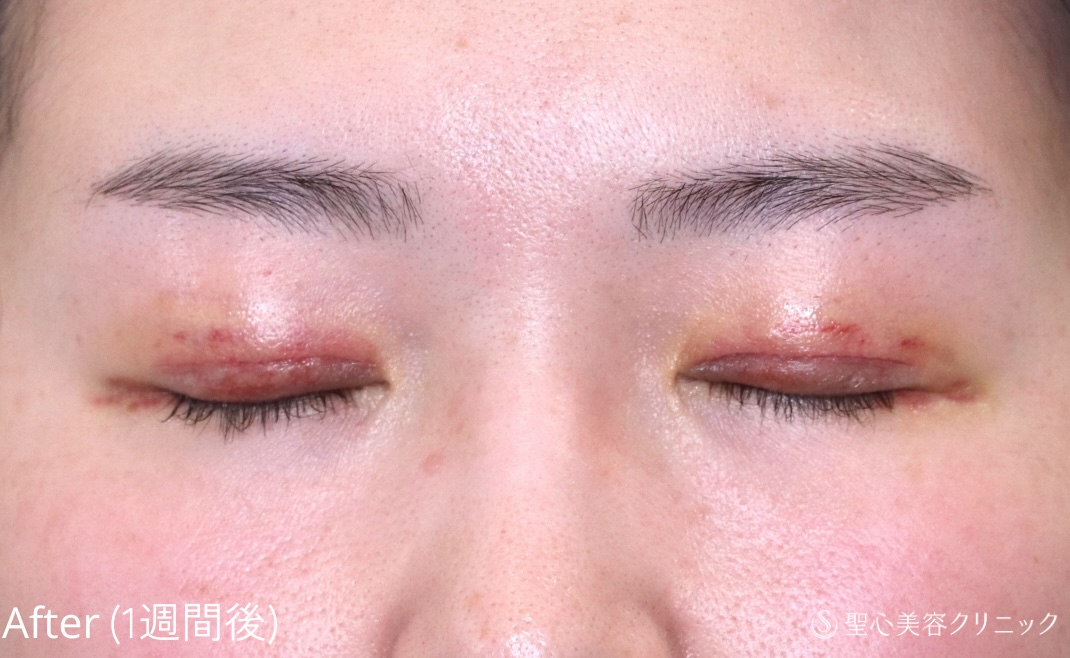 【20代女性・埋没法でゆるんだ二重を引き締める】二重切開法（1週間後） After 