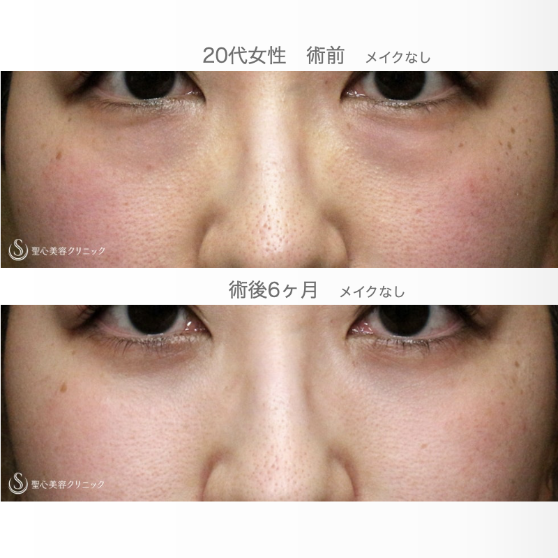 【20代女性・目の下のクマを脱脂だけで】経結膜下脱脂術 単独（術直後〜6ヶ月後） After 