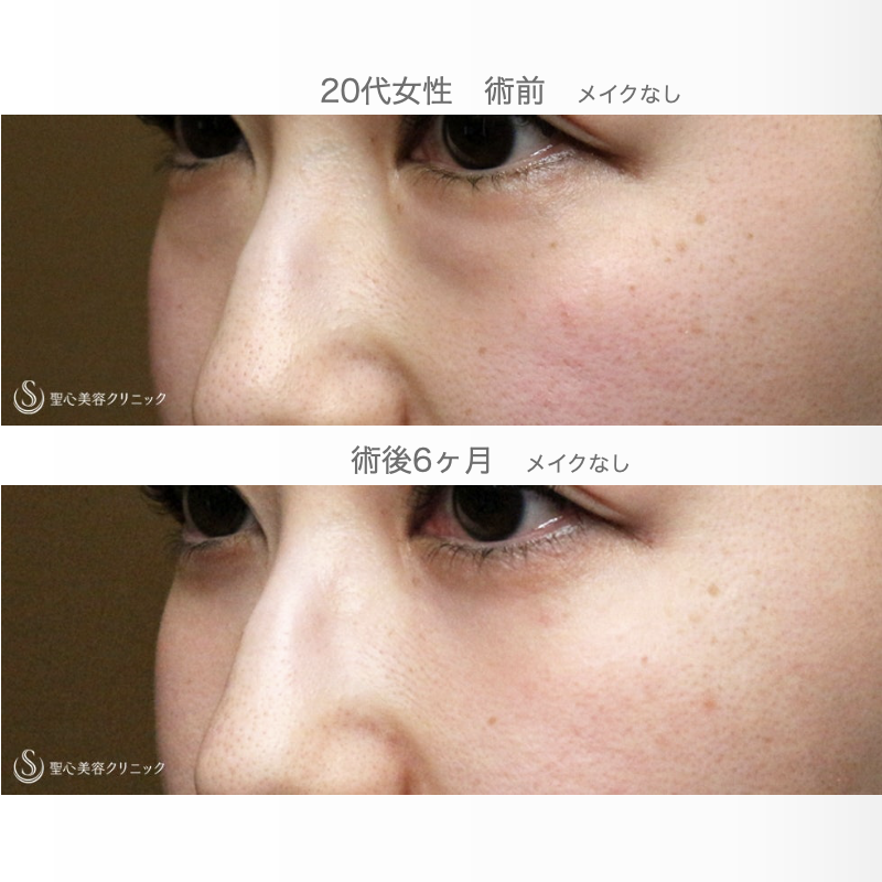 【20代女性・目の下のクマを脱脂だけで】経結膜下脱脂術 単独（術直後〜6ヶ月後） After 