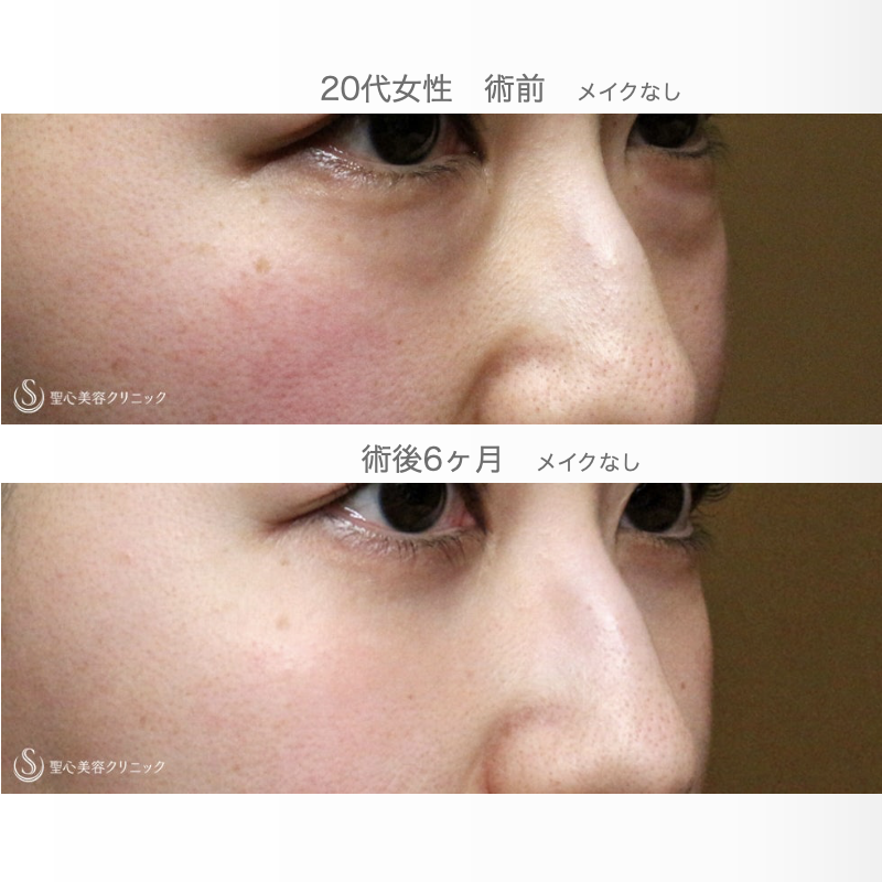【20代女性・目の下のクマを脱脂だけで】経結膜下脱脂術 単独（術直後〜6ヶ月後） After 
