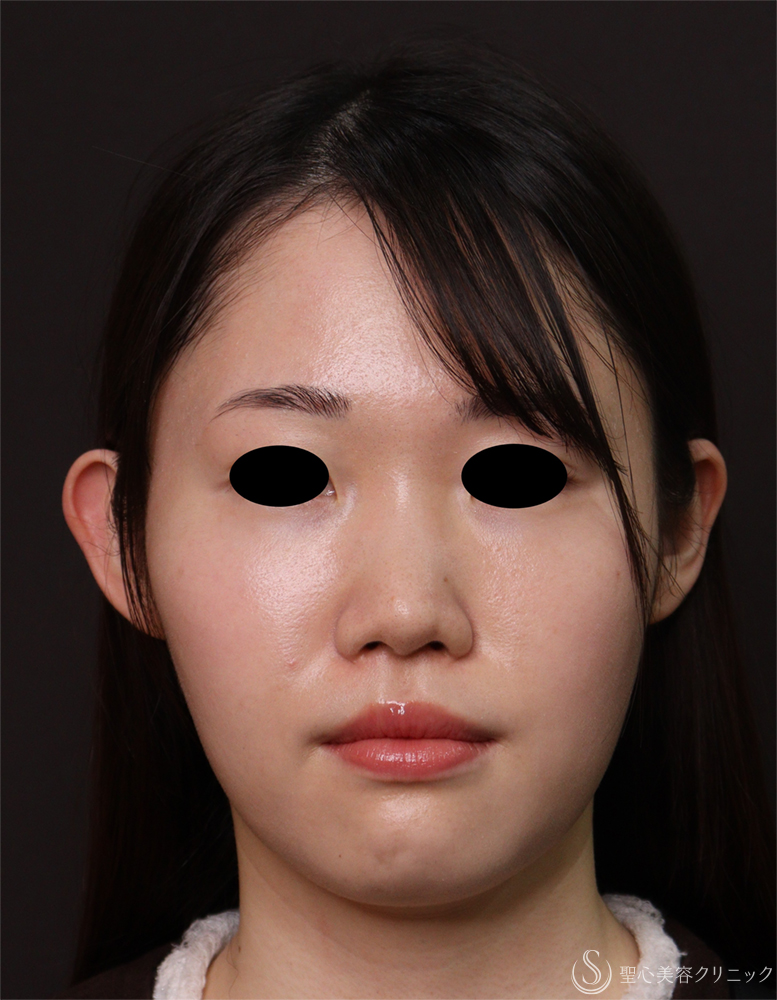 【20代女性・耳の左右差を整える】右立ち耳埋没法（1ヶ月後） Before 