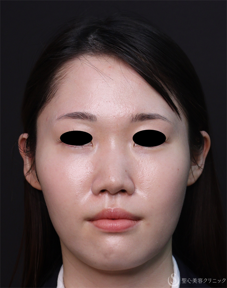 【20代女性・耳の左右差を整える】右立ち耳埋没法（1ヶ月後） After 