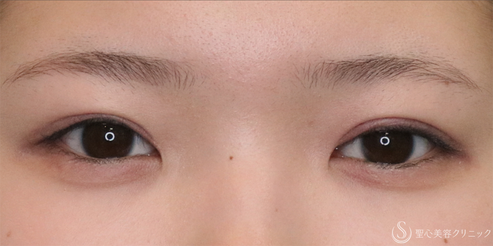 【10代女性・パッチリ二重に】二重全切開術＋脂肪除去（1ヶ月後） After 名古屋+二重　二重切開