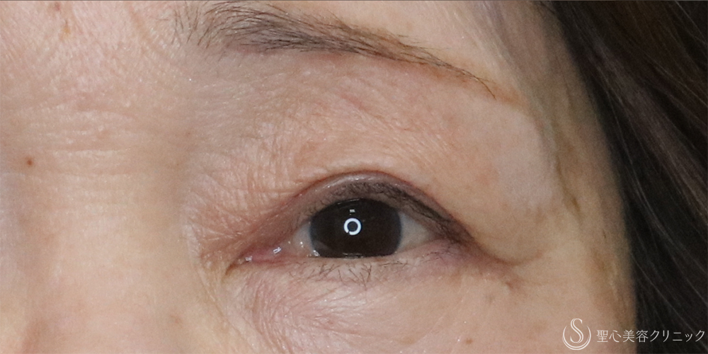 【60代女性・目の開きを改善】眼瞼下垂（切開法）＋眉下切開術（3ヶ月後） After 名古屋+二重　埋没法　眼瞼下垂　まぶたたるみ　眉下切開