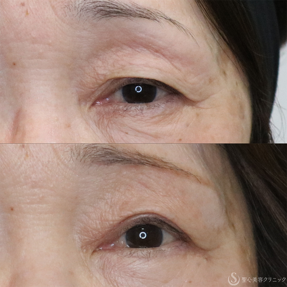 【60代女性・目の開きを改善】眼瞼下垂（切開法）＋眉下切開術（3ヶ月後） After 名古屋+二重　埋没法　眼瞼下垂　まぶたたるみ　眉下切開