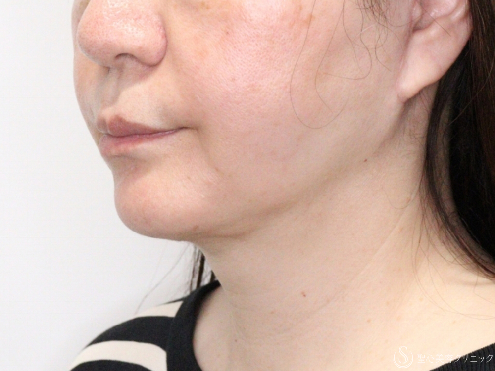 【60代女性・フェイスラインすっきり】プレミアムミニリフト（フェイスライン～顎下の範囲）＋脂肪吸引注射（頬＋顎下）（4ヶ月後） After 