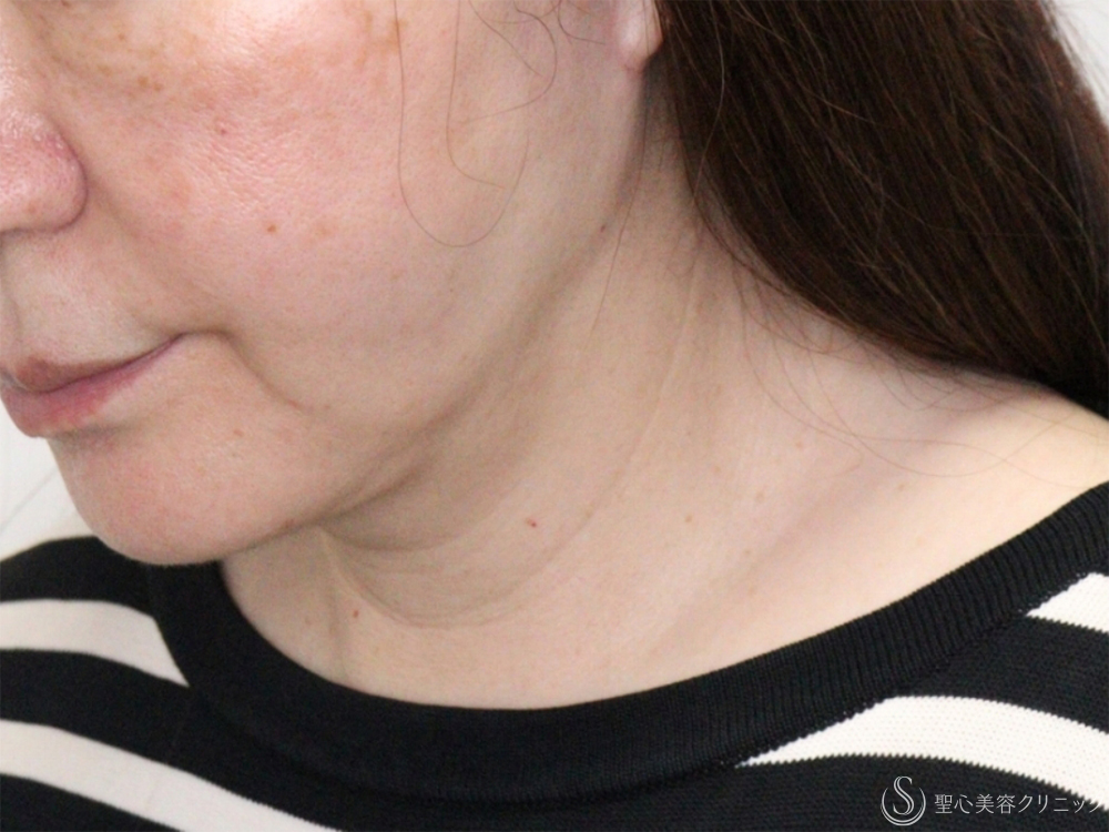 【60代女性・フェイスラインすっきり】プレミアムミニリフト（フェイスライン～顎下の範囲）＋脂肪吸引注射（頬＋顎下）（4ヶ月後） After 