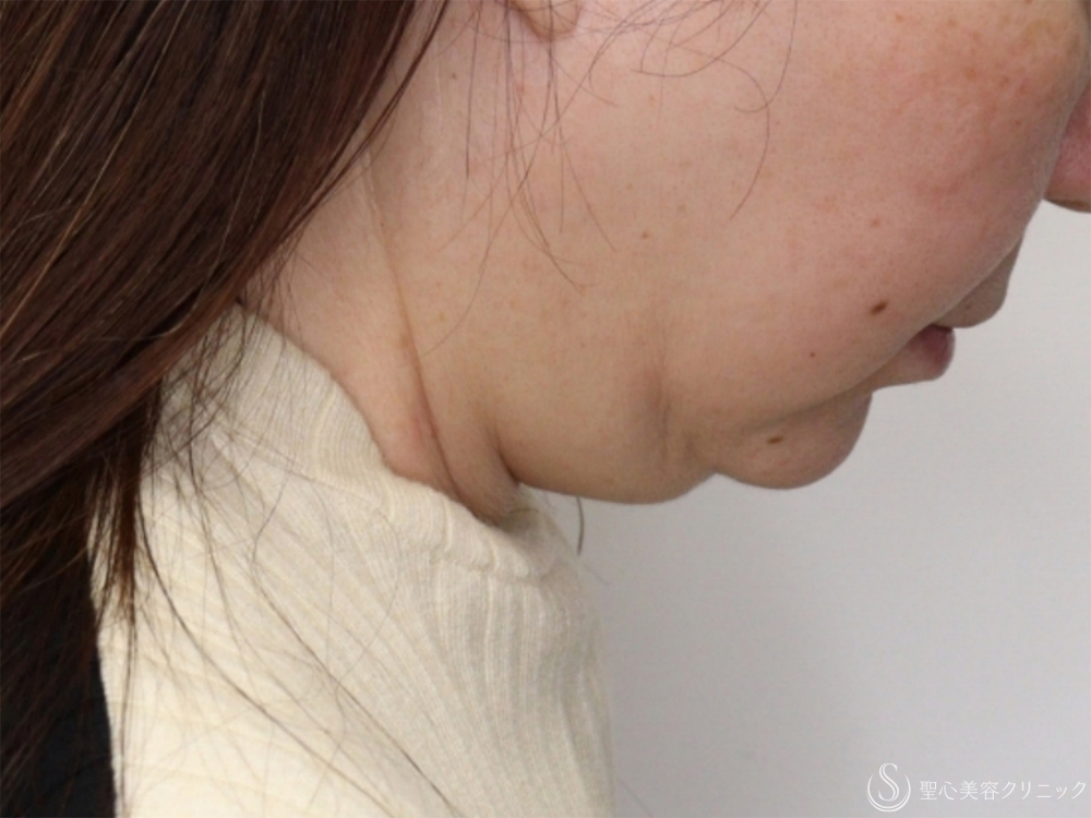 【60代女性・フェイスラインすっきり】プレミアムミニリフト（フェイスライン～顎下の範囲）＋脂肪吸引注射（頬＋顎下）（4ヶ月後） Before 