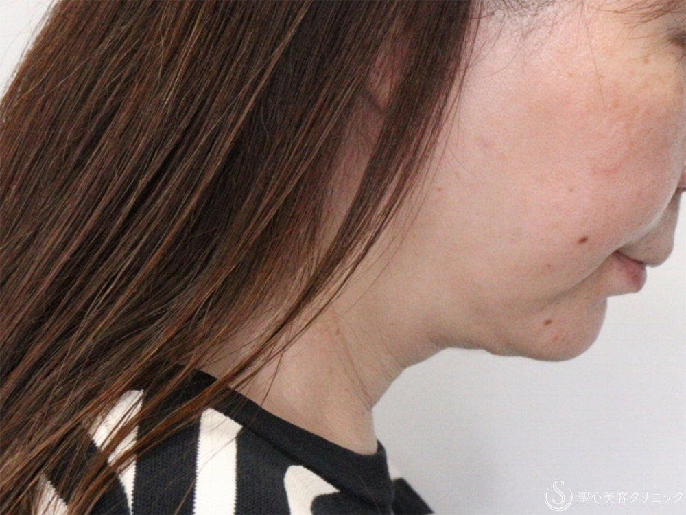 【60代女性・フェイスラインすっきり】プレミアムミニリフト（フェイスライン～顎下の範囲）＋脂肪吸引注射（頬＋顎下）（4ヶ月後） After 