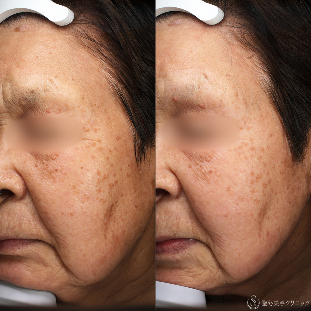 【70代女性・シミを改善しトーンアップ】セレックV＋レタッチピール（5回後） After 名古屋+IPL治療　光治療　しみ　トーンアップ