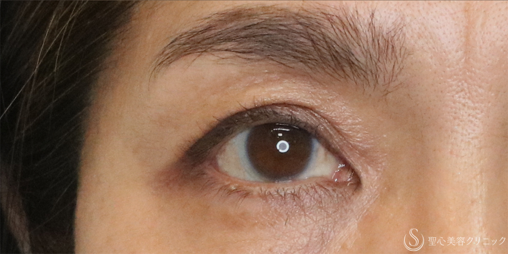 【50代女性・切らずに目の開き改善】眼瞼下垂埋没法（1ヶ月後） After 名古屋+眼瞼下垂　埋没法