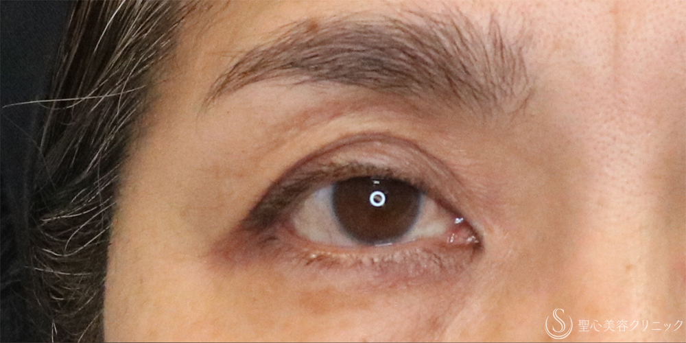 【50代女性・切らずに目の開き改善】眼瞼下垂埋没法（1ヶ月後） Before 名古屋+眼瞼下垂　埋没法