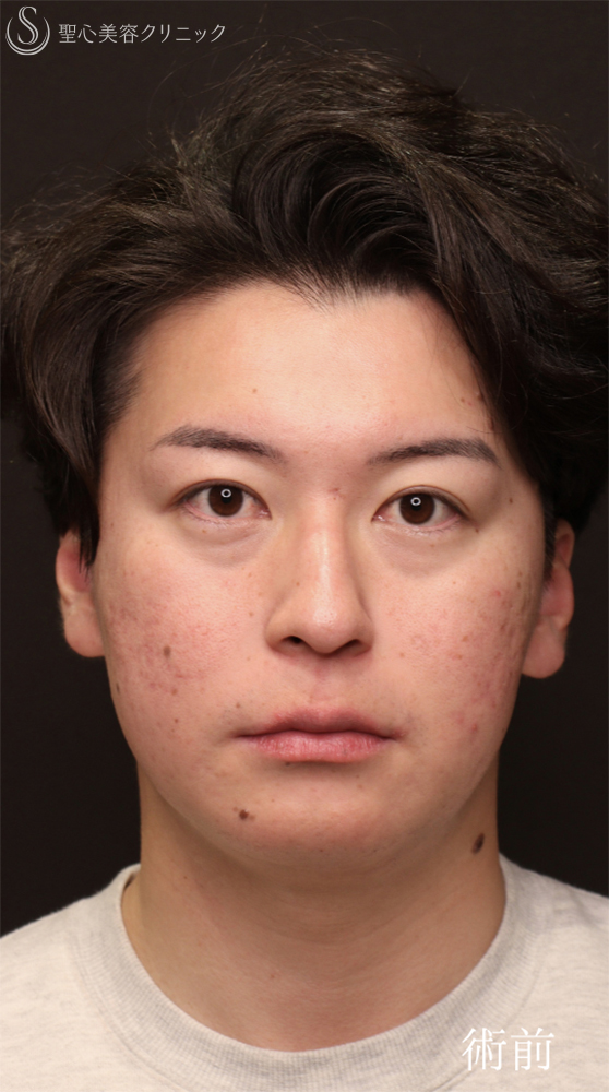 【20代男性・クマ施術で疲れみえを改善】裏ハムラ法（1ヶ月後） Before 
