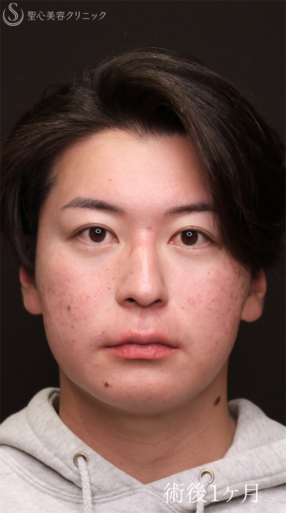 【20代男性・クマ施術で疲れみえを改善】裏ハムラ法（1ヶ月後） After 
