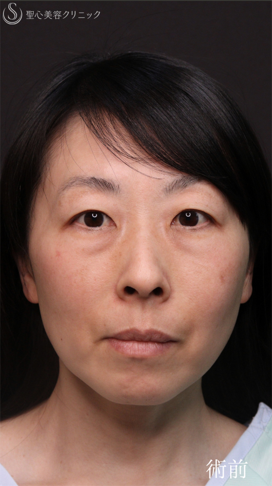 【40代女性・クマ治療で疲れみえをスッキリ改善】裏ハムラ法（直後～1ヶ月後） Before 