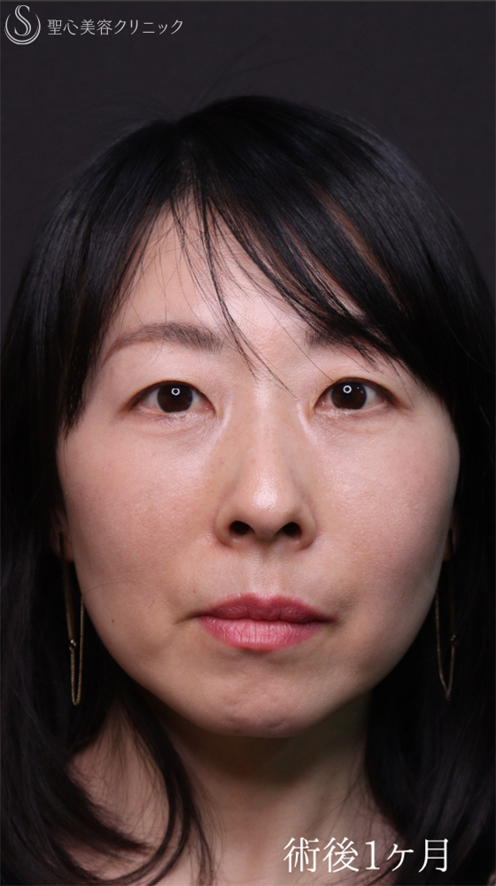 【40代女性・クマ治療で疲れみえをスッキリ改善】裏ハムラ法（直後～1ヶ月後） After 