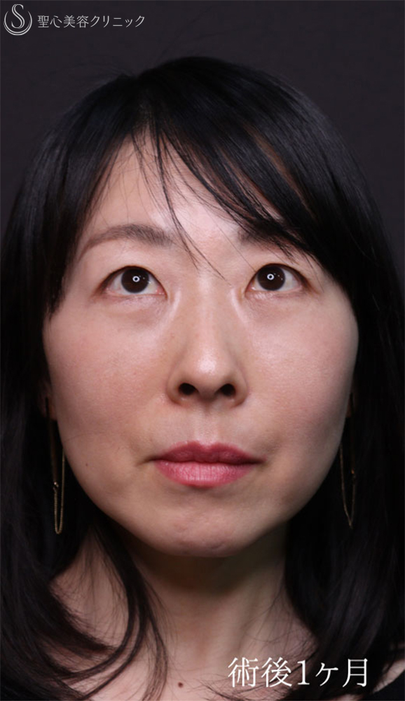 【40代女性・クマ治療で疲れみえをスッキリ改善】裏ハムラ法（直後～1ヶ月後） After 