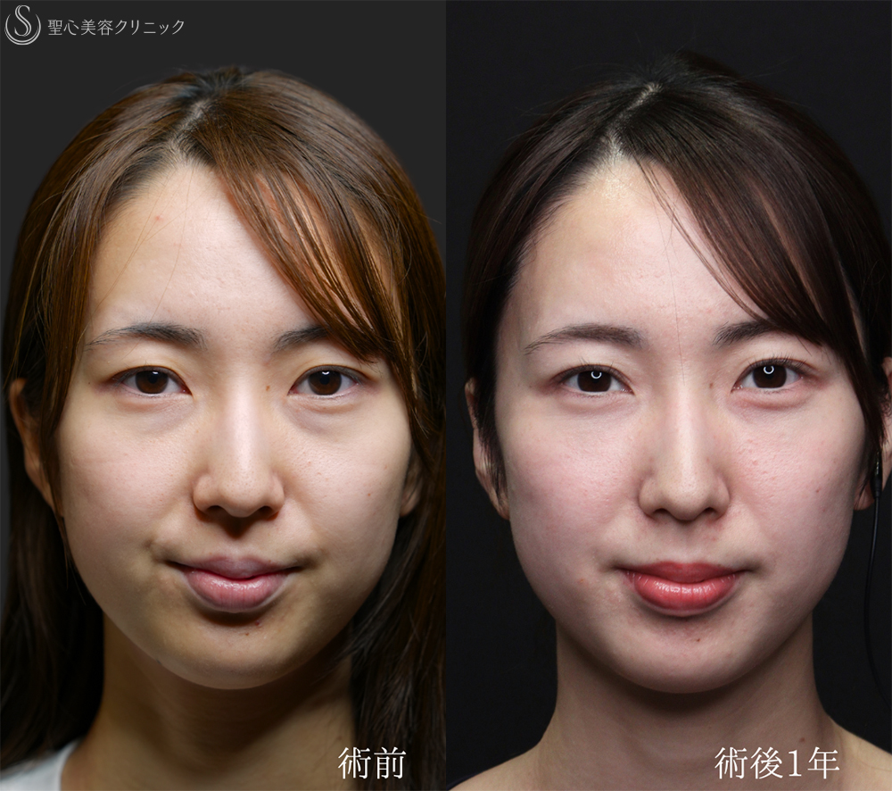 【20代女性・裏ハムラと二重埋没法で目元のナチュラルアップデート】下眼瞼切開術/下眼瞼除皺術/ハムラ法＋ 二重術（埋没法）：マイクロメソッド+α（1ヶ月後～1年後） After 