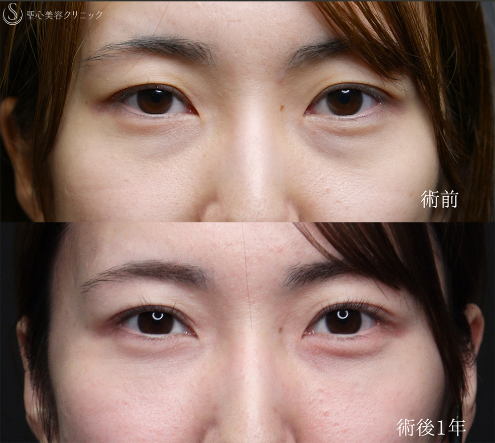 【20代女性・裏ハムラと二重埋没法で目元のナチュラルアップデート】下眼瞼切開術/下眼瞼除皺術/ハムラ法＋ 二重術（埋没法）：マイクロメソッド+α（1ヶ月後～1年後） After 