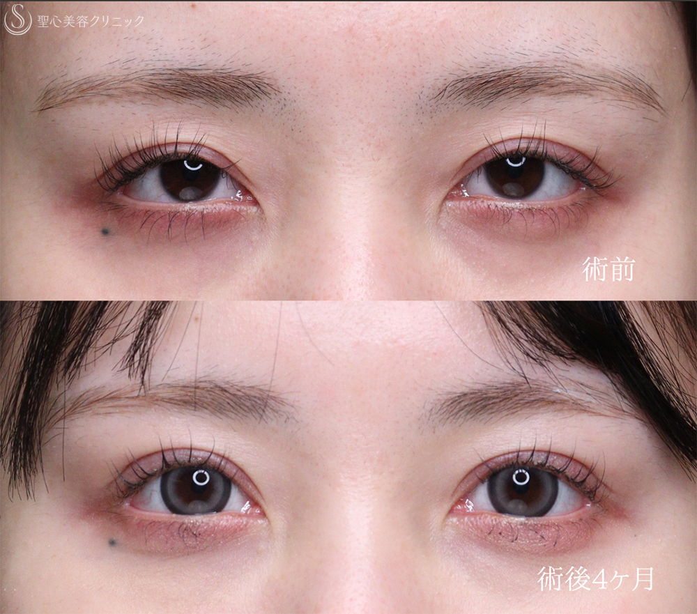 【20代女性・目力をアップ】眼瞼下垂（切開法/腱膜縫縮法）（1週間後～4ヶ月後） After 