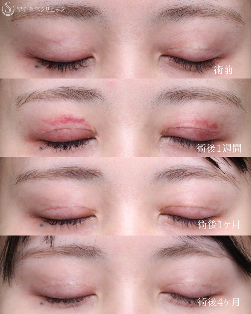 【20代女性・目力をアップ】眼瞼下垂（切開法/腱膜縫縮法）（1週間後～4ヶ月後） After 