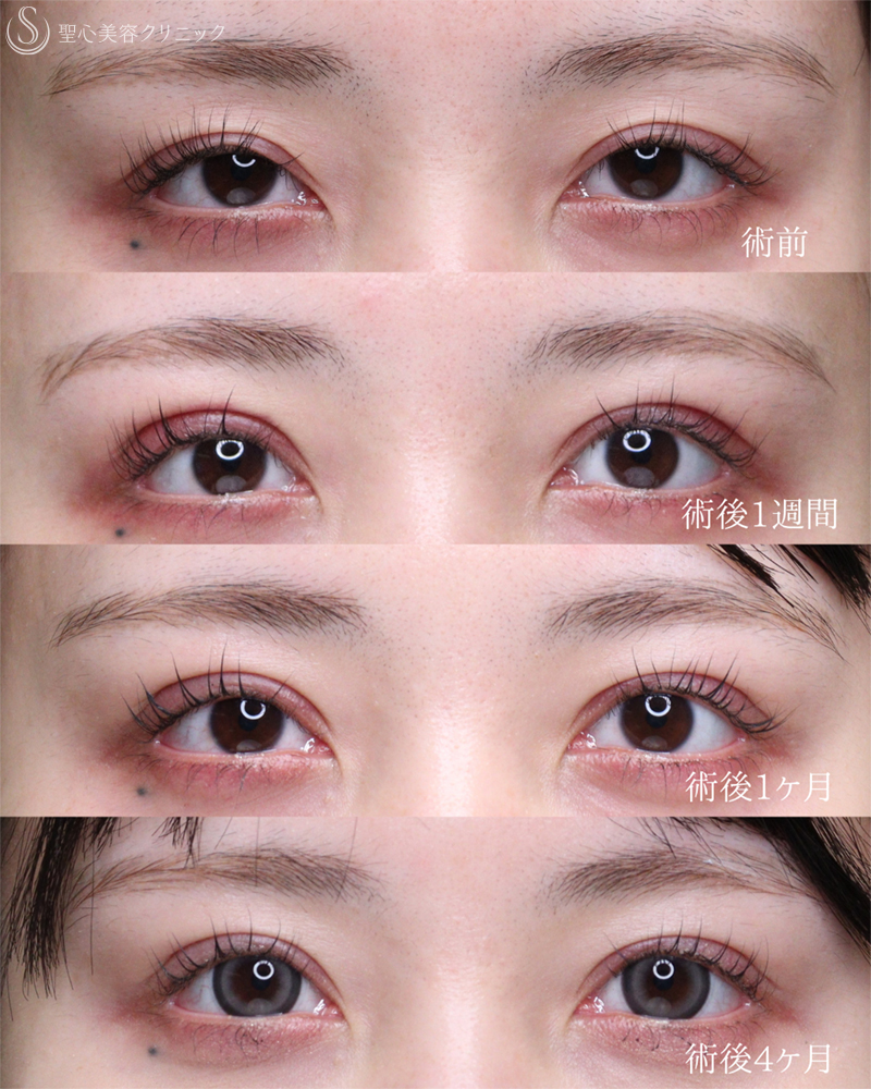 【20代女性・目力をアップ】眼瞼下垂（切開法/腱膜縫縮法）（1週間後～4ヶ月後） After 
