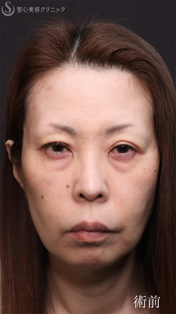 【50代女性・クマ治療で劇的な若返り】ハムラ法＋ミッドチークリフト（直後～1ヶ月後） Before 